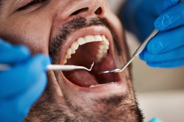 Best Knocked-Out Tooth (Avulsed Tooth) Treatment in Mount Joy, PA